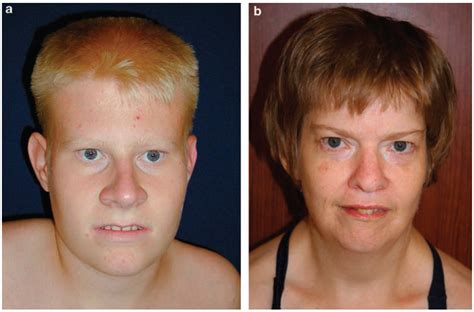 prada willis syndrome|prader willi syndrome pictures adults.